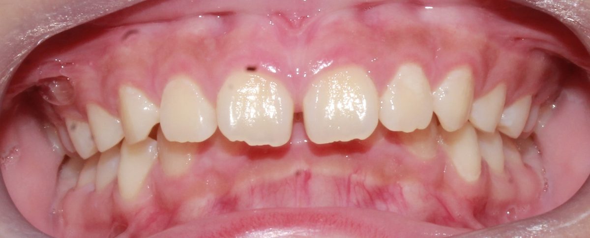 Vivid Smiles patient case 6 before and after treatment comparison before